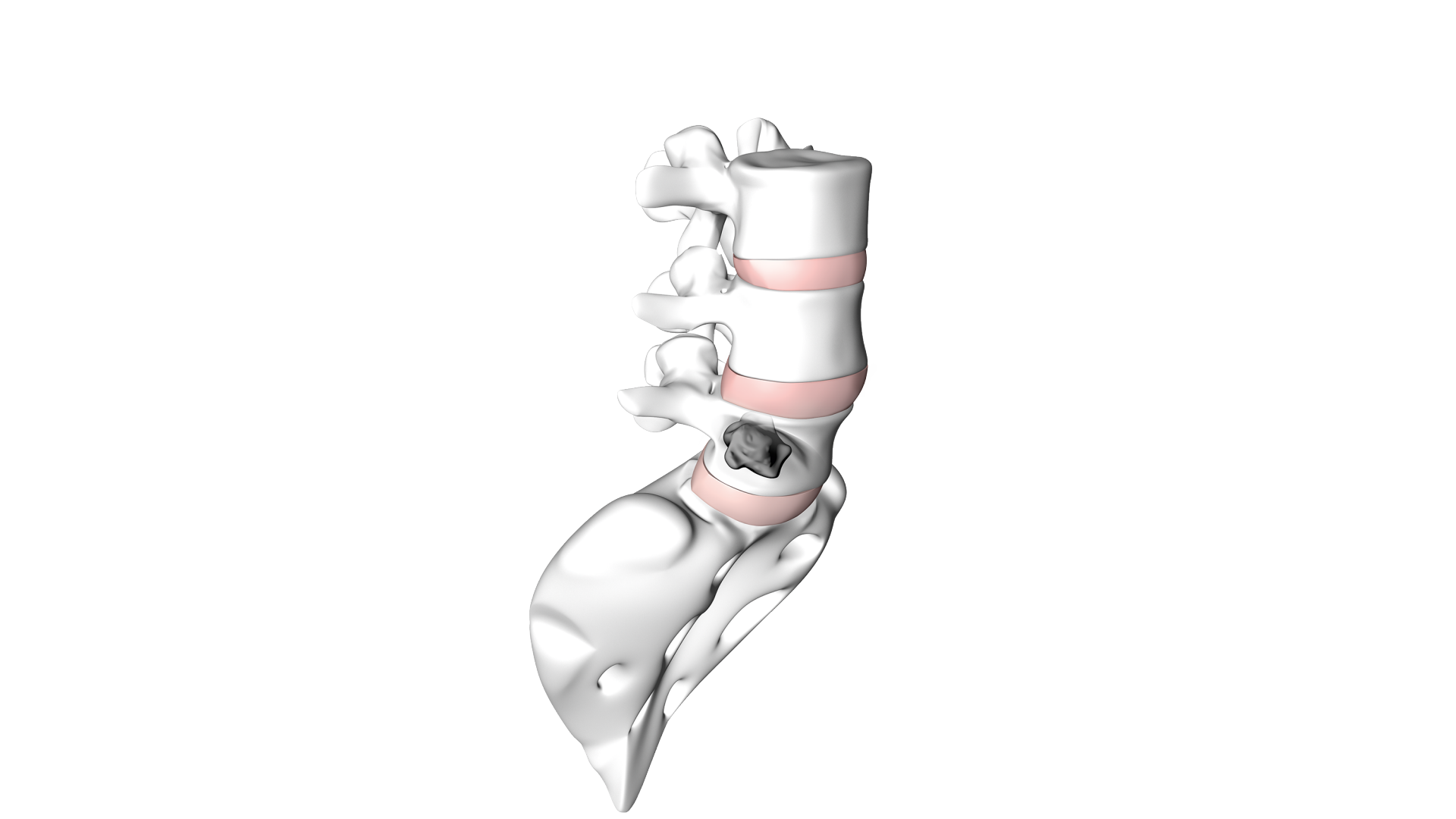 Spinal metastases