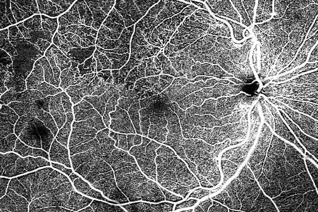 AngioPlex OCT Angiography con una única captura en 12×12 mm con ZEISS CIRRUS 6000 de una oclusión de rama venosa de la retina (ORVR)