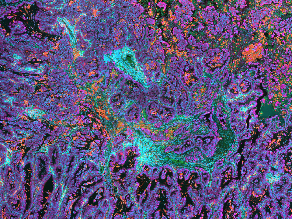 NSCLC tissue stained with UltiMapper I/O PD-L1 kit. Picture detail.